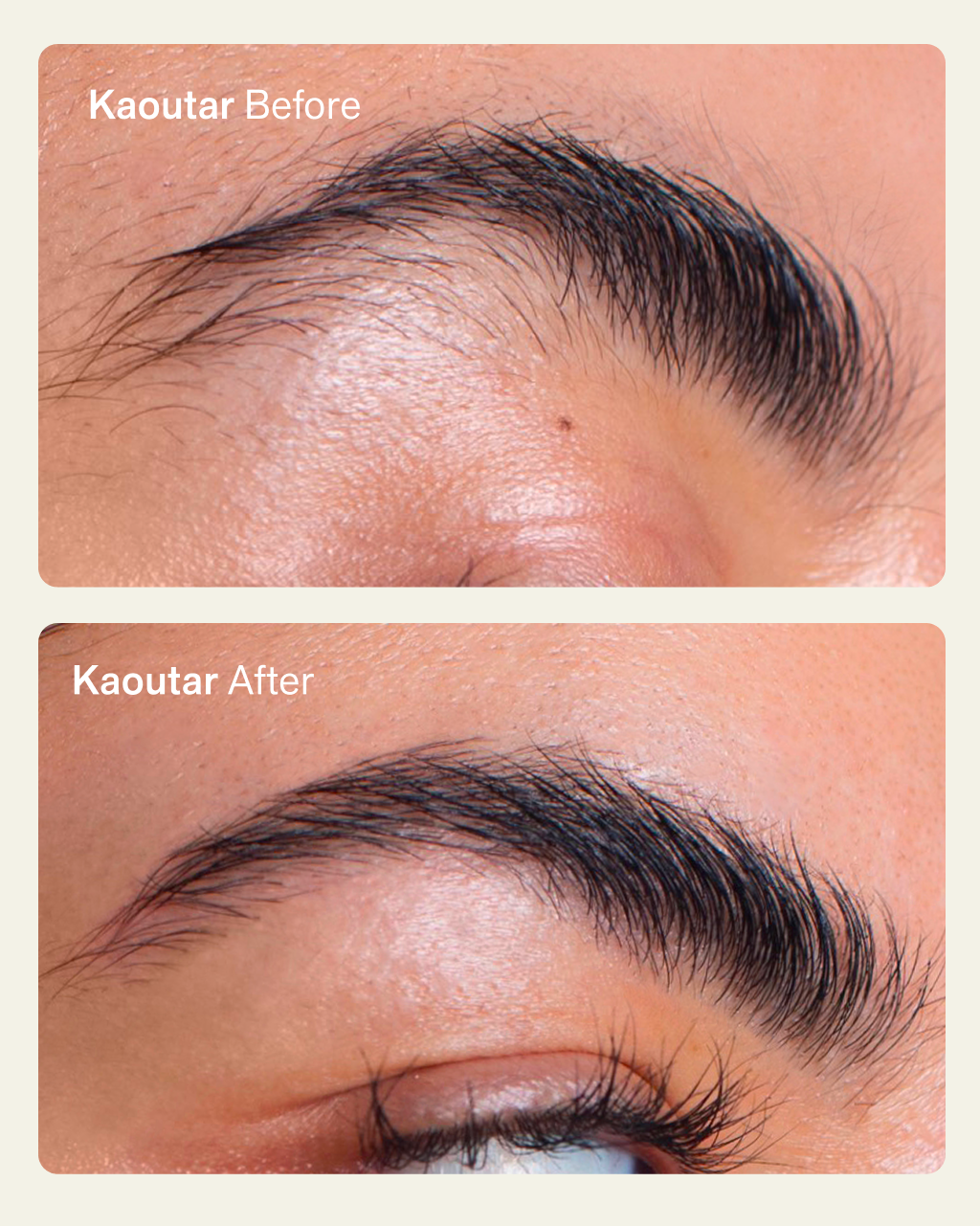 NIMBI Skin Renewal Dermaplaning Kit