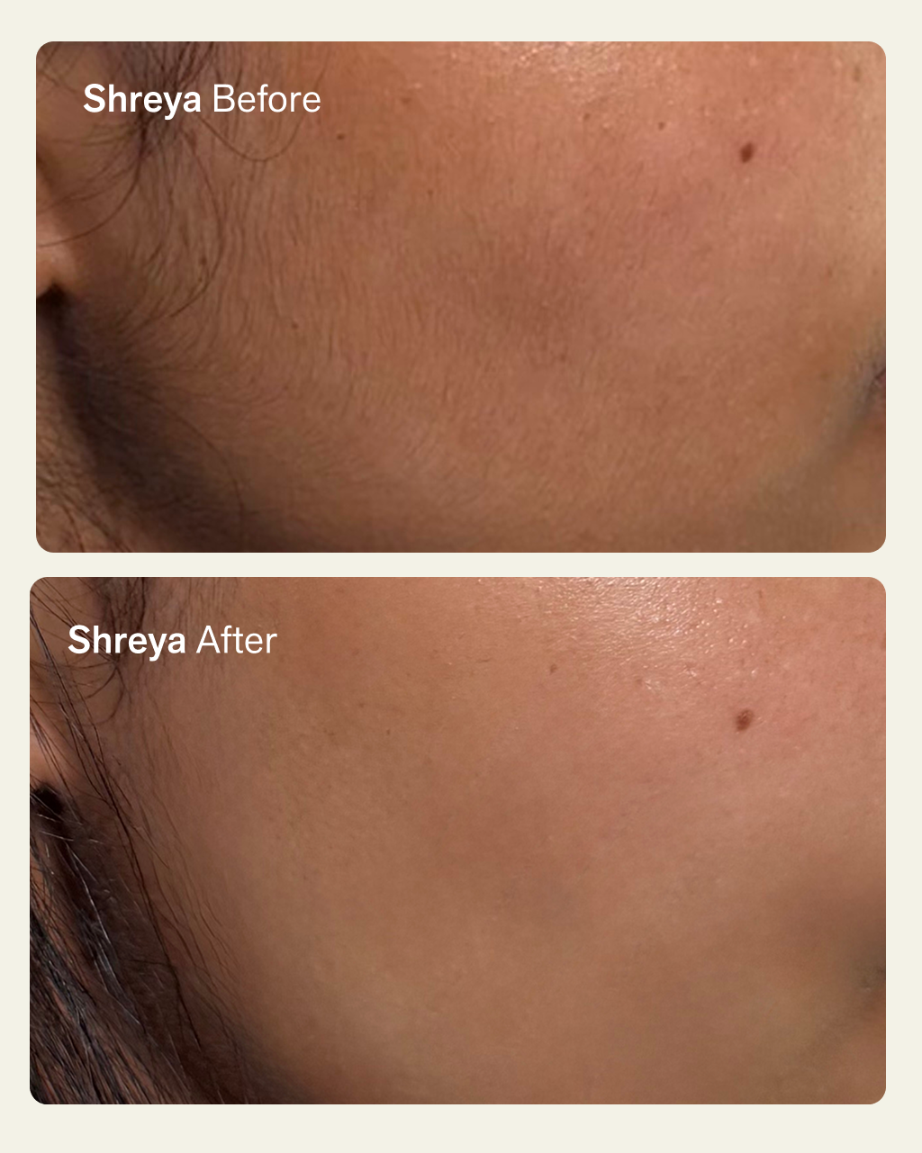 NIMBI Pillow Slip Dermaplaner Oil