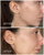 NIMBI Facial Dermaplaners